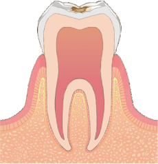 C1:歯の表面(エナメル質)のむし歯