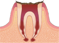 C4:歯の根まで進行したむし歯