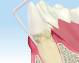 歯周病を治す3つの治療法